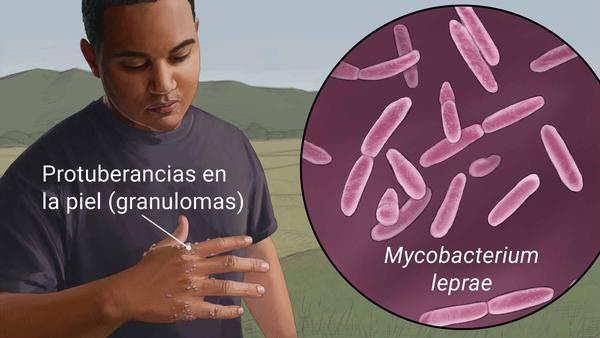 Hay cinco casos de lepra en la Península de Yucatán
